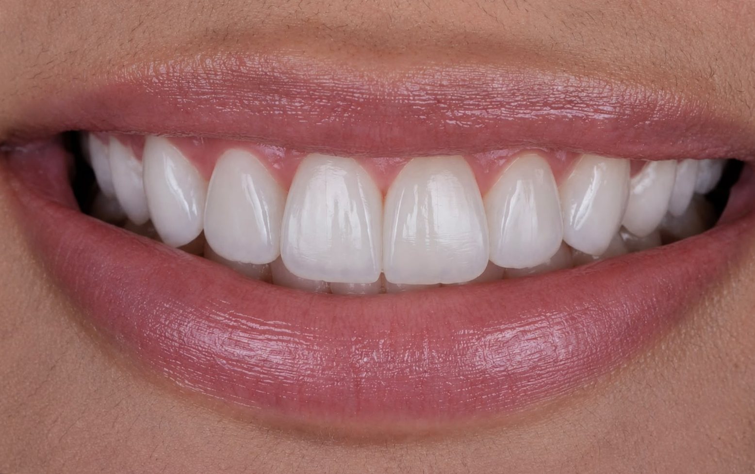 Sorriso depois das facetas de resina