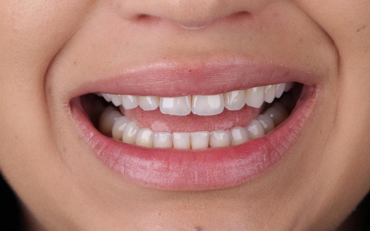 Sorriso da paciente antes do procedimento