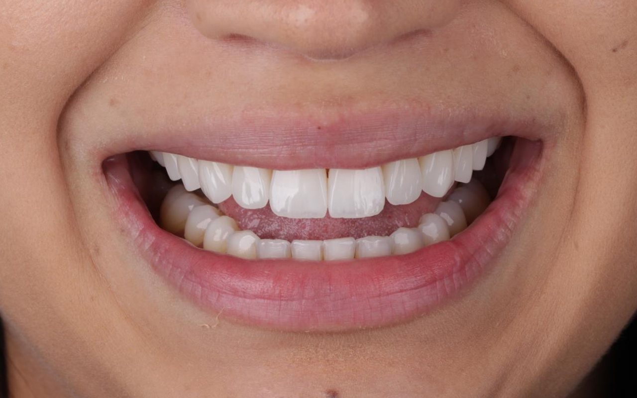 Sorriso da paciente depois do procedimento