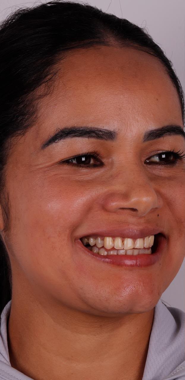 Paciente sorrindo antes do tratamento