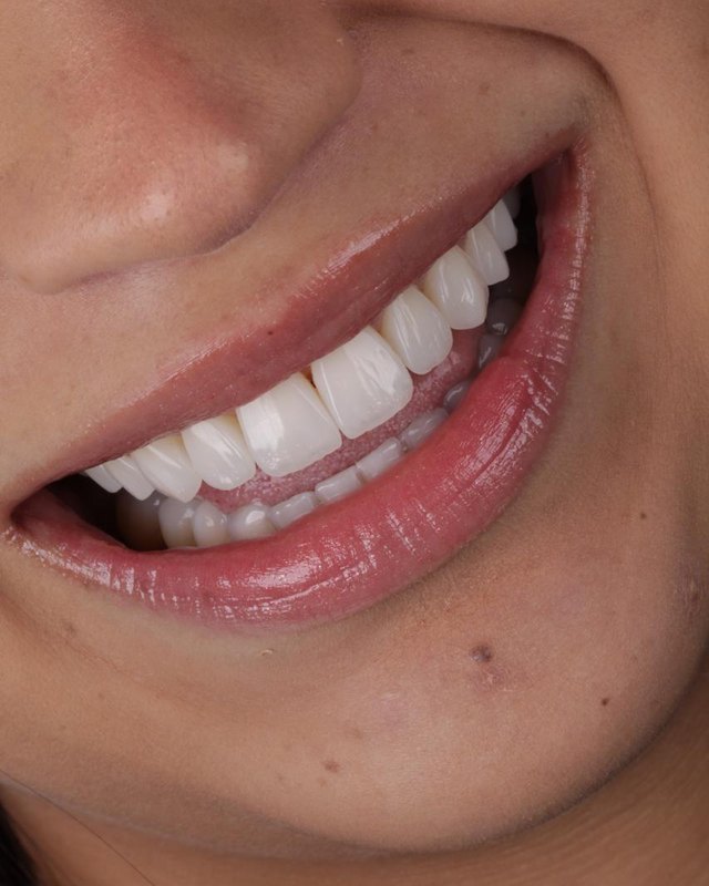 Detalhe de um sorriso com lentes