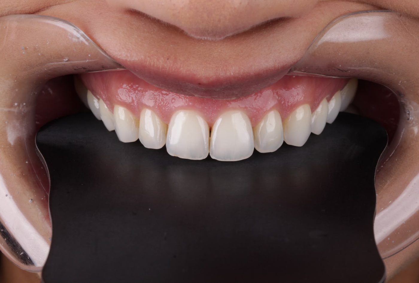 Sorriso antes do tratamento, vista frontal com afastador