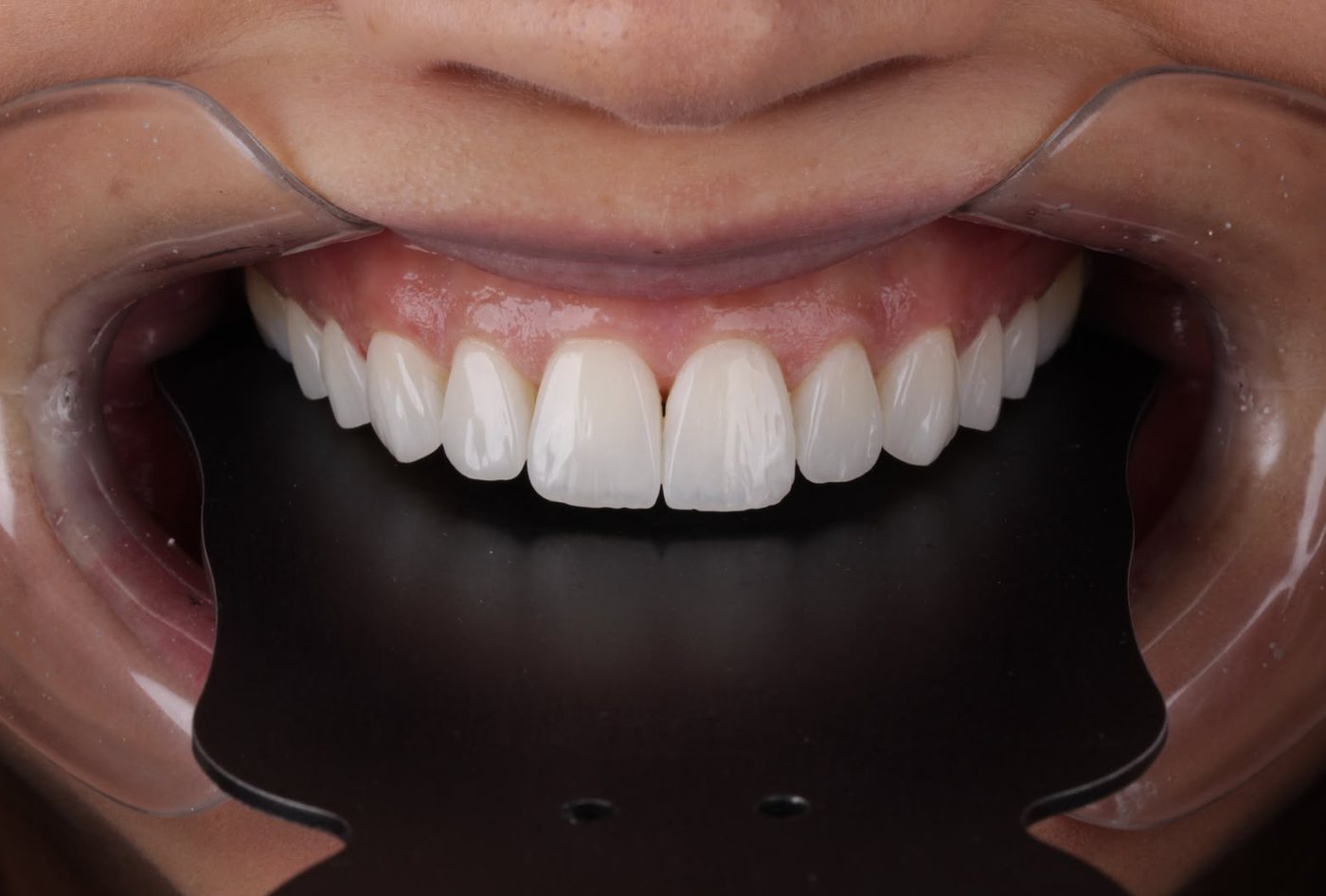 Sorriso depois do tratamento, vista frontal com afastador