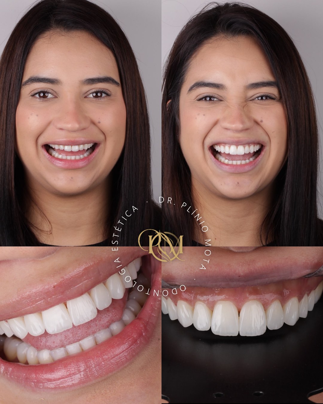 Antes e depois de uma paciente: rosto e sorriso antes do tratamento à esquerda, depois à direita